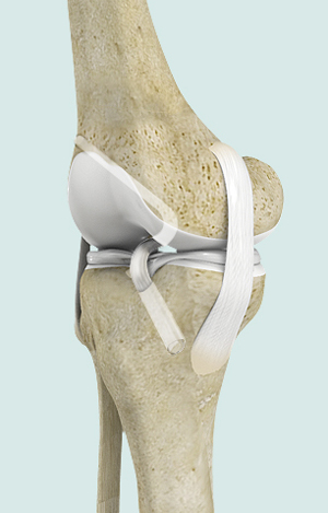 TAnterior Cruciate Ligament ACL Reconstruction