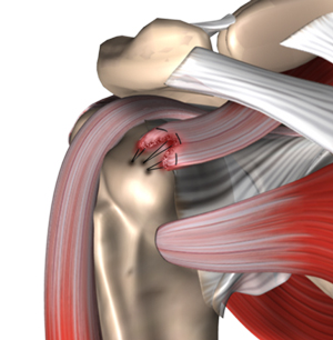 Rotator Cuff Repair