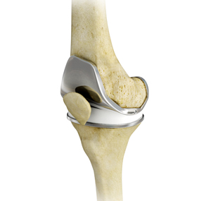 Total Knee Replacement (TKR)